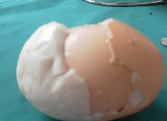 Phía dưới lớp lòng trắng vẫn còn một quả trứng nữa.