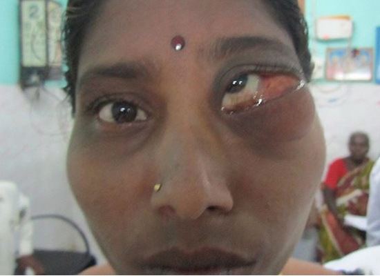 Khi sinh ra, cô Nagabhushanam Siva đã có khối u to bất thường bên mắt trái