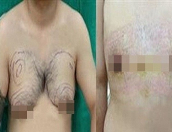 Bộ ngực của chàng trai 25 tuổi trước và sau phẫu thuật.