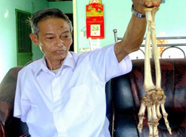 Người thương binh sau nửa thế kỷ bỗng gặp lại cánh tay mình