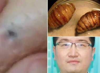 Phát hiện 20 ấu trùng của giòi ăn thịt dưới da
