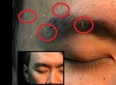 Giòi lúc nhúc bò lên từ da mặt một người đàn ông