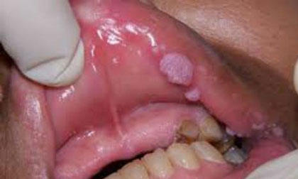 Con 2 tuổi mắc sùi mào gà chỉ vì nụ hôn của mẹ