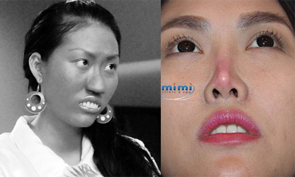 Phi Thanh Vân gánh chịu hậu quả phẫu thuật thẩm mỹ 10 năm trước