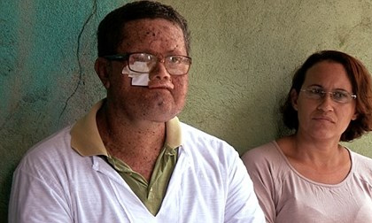 Brazil: Cả thị trấn mặt biến dạng vì mắc bệnh lạ