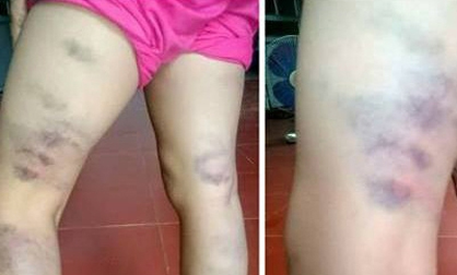 Sa thải cô giáo đánh tím chân học sinh vì viết sai chính tả