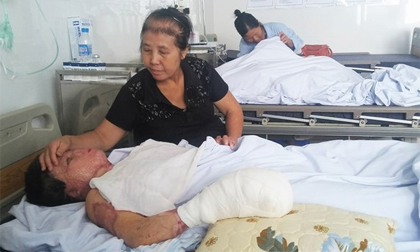 Cô gái bị chồng tưới xăng đốt được phẫu thuật tay phải