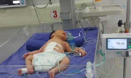 Cứu sống bé sơ sinh 1 giờ tuổi lộ nội tạng ra ngoài thành bụng