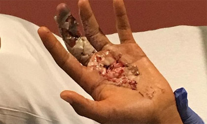 Kinh hãi cậu bé 13 tuổi bị nhiễm virus ăn thịt từ mũ bảo hiểm