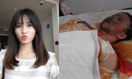 Nữ cử nhân xinh đẹp bị bỏng toàn thân sau khi gặp tai nạn đã trút hơi thở cuối cùng