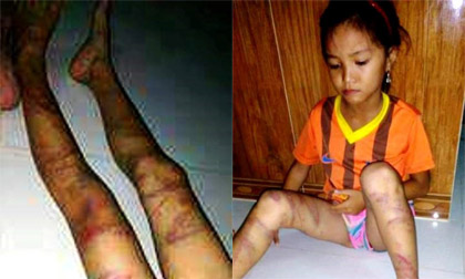 Quảng Bình: Làm rõ việc bé gái bị bạo hành bởi cha đẻ