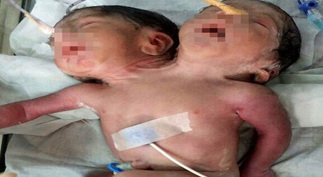 Bé trai dị tật 2 đầu qua đời 32 tiếng đồng hồ sau khi sinh