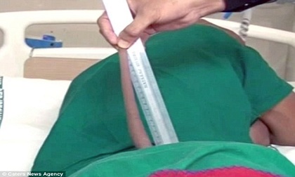 Chuyện lạ: Nam thanh niên 'sót' chiếc đuôi dài gần 18cm