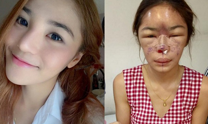 Khuôn mặt xinh đẹp biến dạng đáng sợ vì phẫu thuật thẩm mỹ của cô gái trẻ