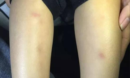 Đặt bút ghi âm trong balo của con, phát hiện cô giáo MN đâm kim vào người con vì không chịu ngủ trưa