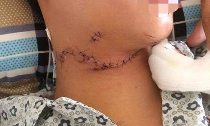Hai học sinh đi xe đạp điện ngã vào đống tôn, 1 bị cứa cổ, 1 đứt tai