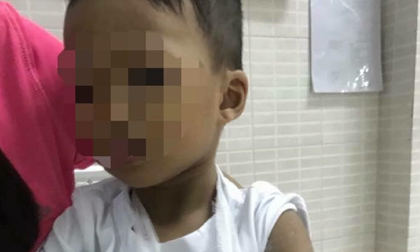 Bé trai 3 tuổi đi học mẫu giáo bị cô giáo đánh gẫy tay