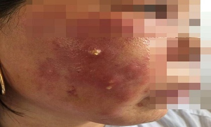 Làm đẹp bằng tiêm thuốc làm trắng da: Hai mẹ con nhập viện