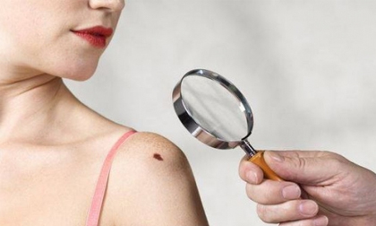 Những vị trí của nốt ruồi cảnh báo trước bệnh tật khôn lường