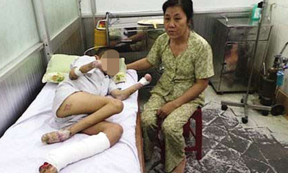 Khủng khiếp với căn bệnh lạ quái ác gặm nhấm rụng dần tay chân