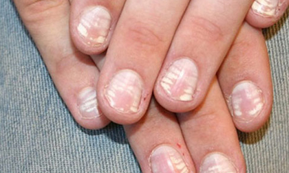 Môi bợt, da xanh, móng tay dễ gãy là bệnh gì?