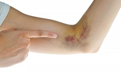 Dấu hiệu đơn giản nhận biết ngay bệnh ung thư máu