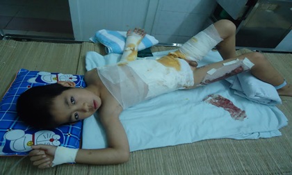 Mâu thuẫn với hàng xóm, đá văng chảo mỡ khiến 2 cháu bé bỏng nặng