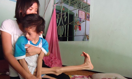 Chữa dứt điểm bại não, tự kỷ nhờ ứng dụng ghép tế bào gốc