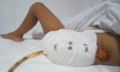 Nhân viên y tế tự cắt chân quyết không nối lại