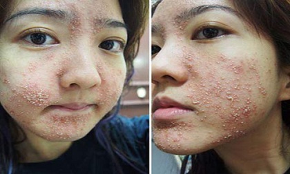 Làn da bị phá hủy vì thói quen dùng dầu dừa sai cách của hàng nghìn chị em
