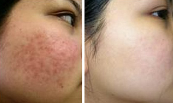 mặt nạ nghệ trị mụn 0
