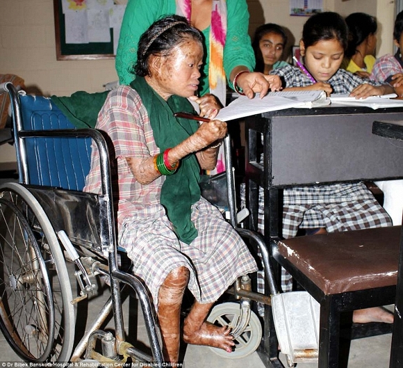 Cuộc sống khốn khó đầy nghị lực của bé gái 13 tuổi mắc bệnh lạ 2