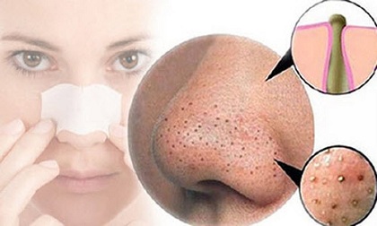 Mẹo trị mụn đầu đen tại nhà đơn giản và tiết kiệm
