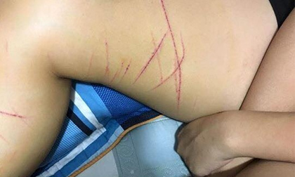 Xôn xao thông tin thiếu nữ bị kẻ biến thái dùng dao tem rạch đùi ở Hà Nội