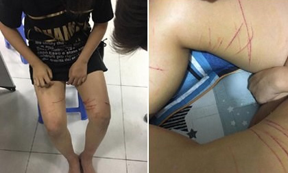 Công an đang điều tra vụ cô gái bị kẻ biến thái rạch đùi