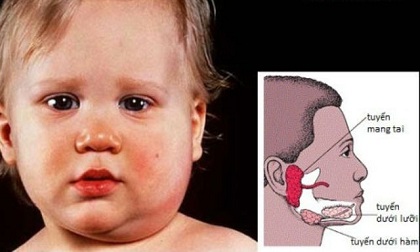 Xử lý và phòng ngừa bệnh quai bị