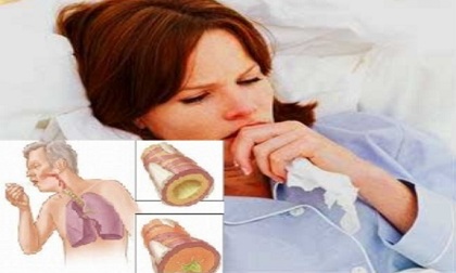 Bệnh lao và biến chứng nguy hiểm