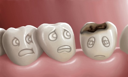 Cách trị sâu răng đơn giản, hiệu quả