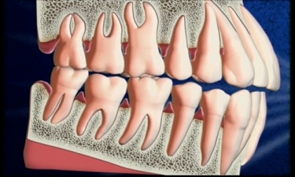 Chớ xem nhẹ bệnh nướu răng
