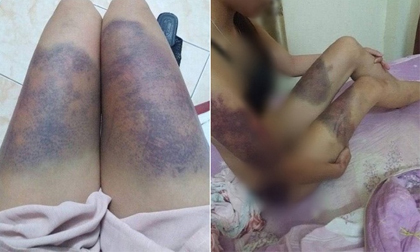 Cô gái trẻ tố bị bạn trai hành hung bầm dập khắp người