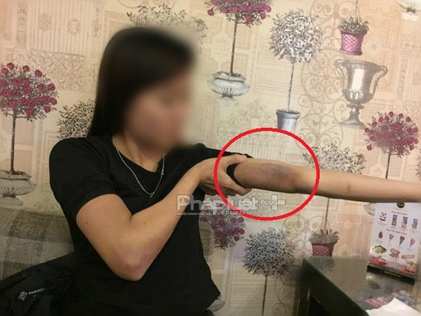 Sau nhiều ngày từ khi bị hành hung, những vết thâm tím trên cơ thể chị H. vẫn còn rõ.