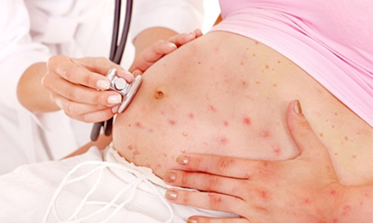 Những điều cần lưu ý cho mẹ bầu bị thủy đậu