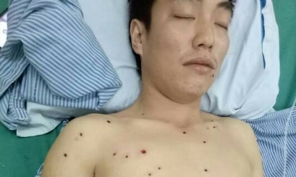 Hà Giang: Bị đối tượng lạ nã 53 viên đạn hoa cải vào người