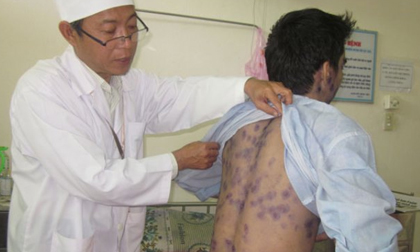 Tin nóng sáng 8/2: Nguy cơ bùng phát dịch bệnh thủy đậu ở Hà Nội