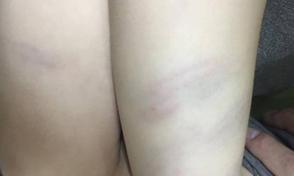 Thanh Hóa: Cô giáo dùng đũa đánh vào đùi bé gái 2 tuổi