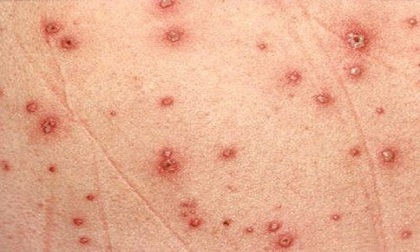 Bác sĩ Nhi khoa lưu ý cách điều trị thủy đậu cho trẻ đúng cách