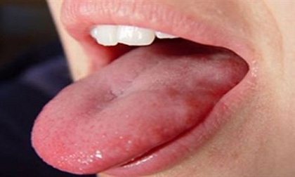 7 loại bệnh về lưỡi thường gặp