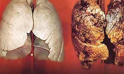 4 loại quả ăn vào lọc sạch phổi cho người hút thuốc lá
