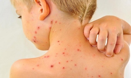 Bố mẹ nhầm bệnh thủy đậu với bệnh sởi, nhiều trẻ nguy kịch
