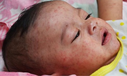 Tin nóng sáng 22/2: 20 học sinh nghi bị viêm cầu thận, 2 anh em ruột tử vong